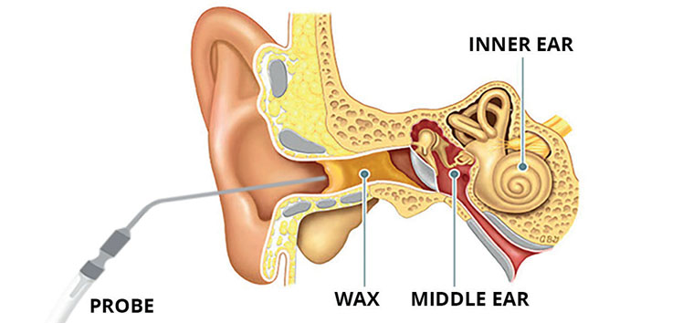 best ear wax removal clinic near me